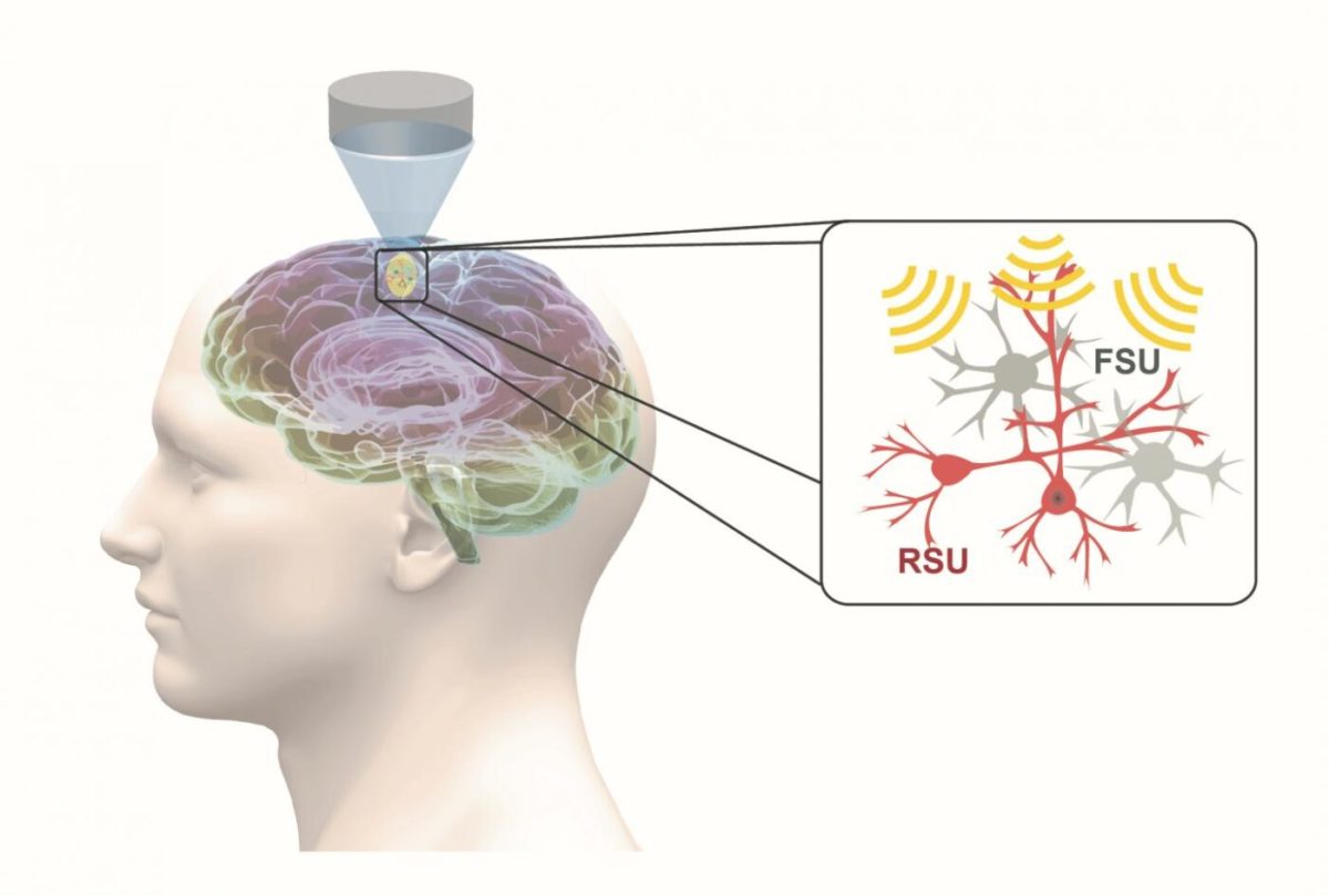 Ultrasound Offers Focused Noninvasive Option for Neuropsychiatric Disorders