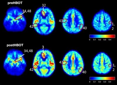 Emerging Peer-Reviewed Study Shows Reversal in Biological Hallmarks Responsible for Development of Alzheimer’s Disease