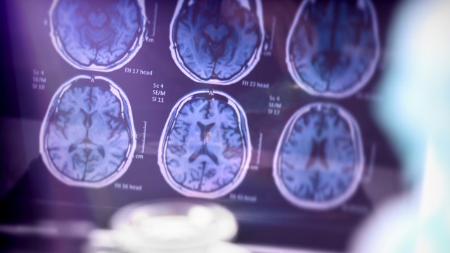 Three Advances in Alzheimer’s Disease Diagnostics