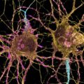 How Huntington’s Disease Affects Different Neurons
